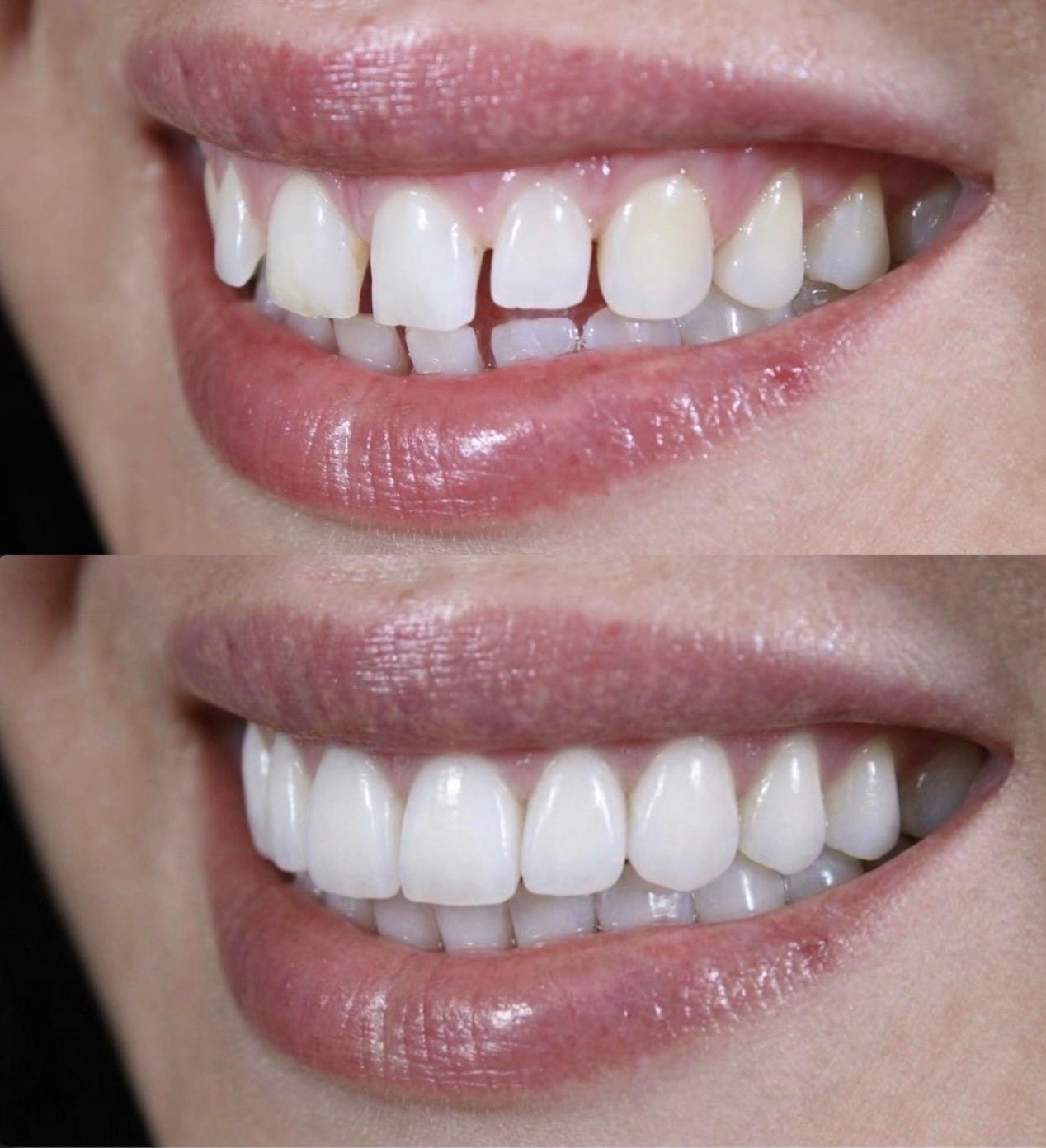 Hasta gülüş dönüşümü 6