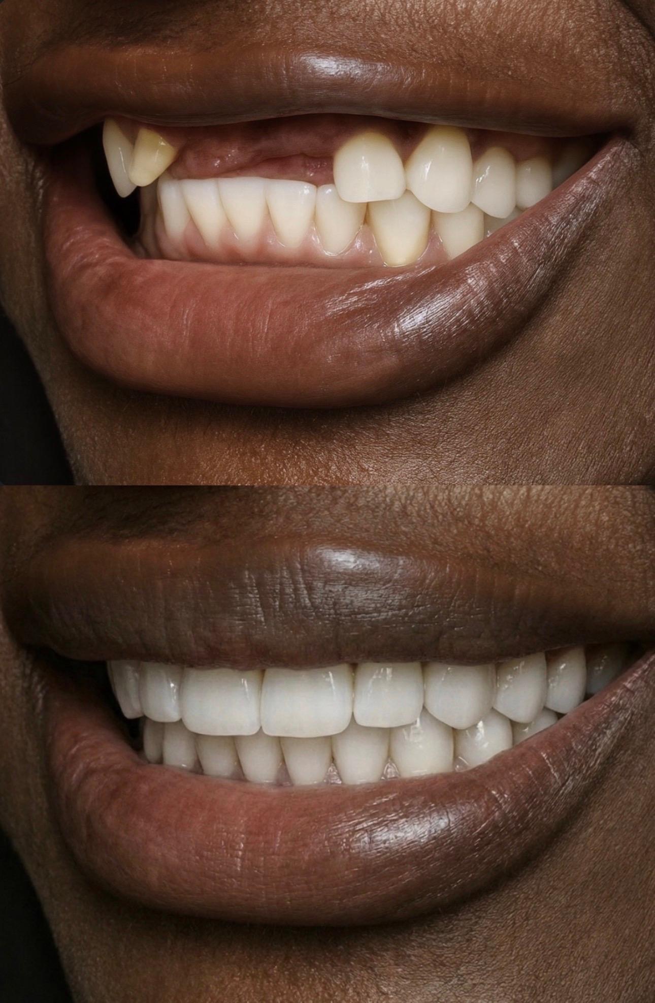 Hasta gülüş dönüşümü 12