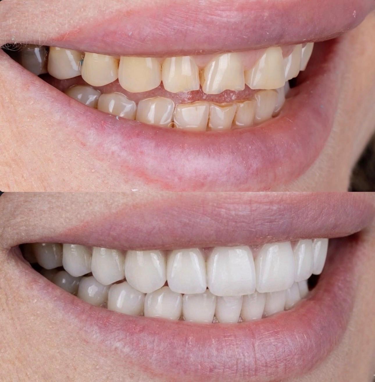 Hasta gülüş dönüşümü 15