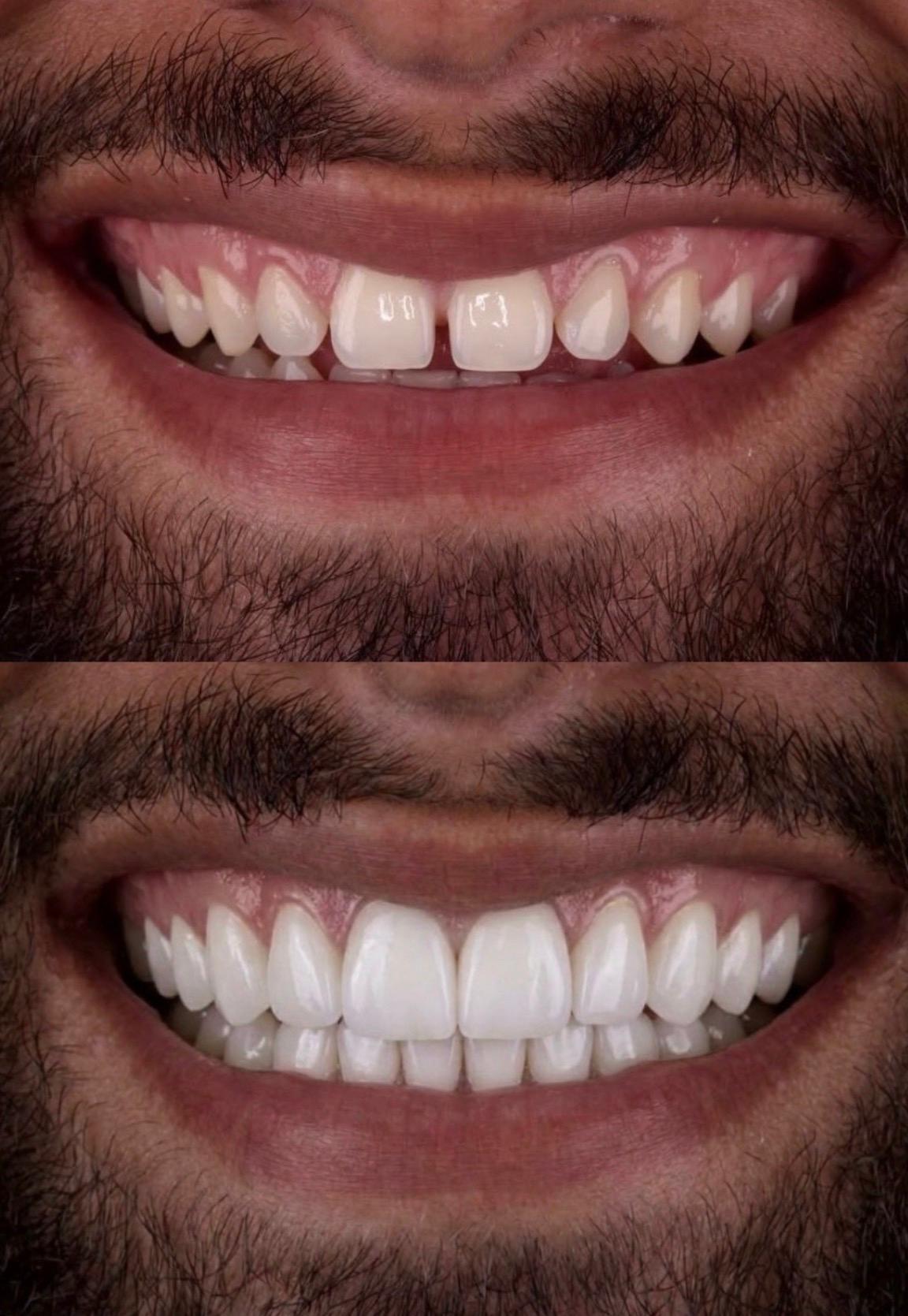 Hasta gülüş dönüşümü 24