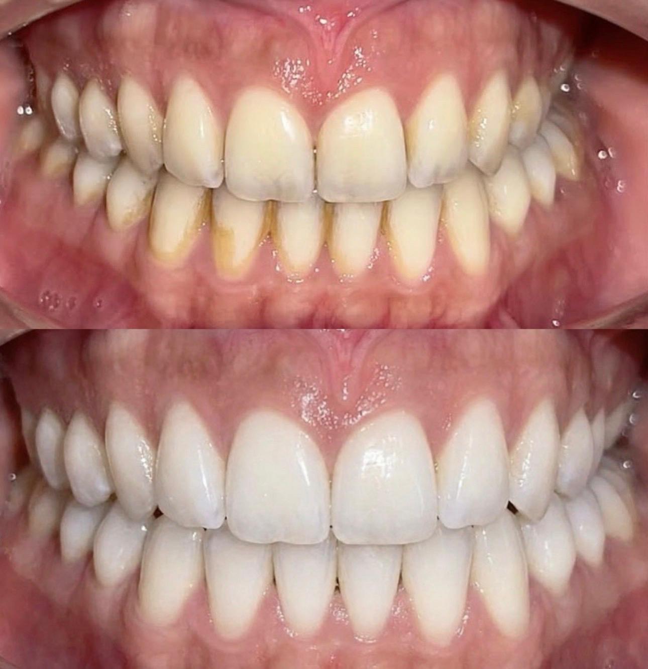 Diş Beyazlatma Öncesi ve Sonrası Sonuçlar